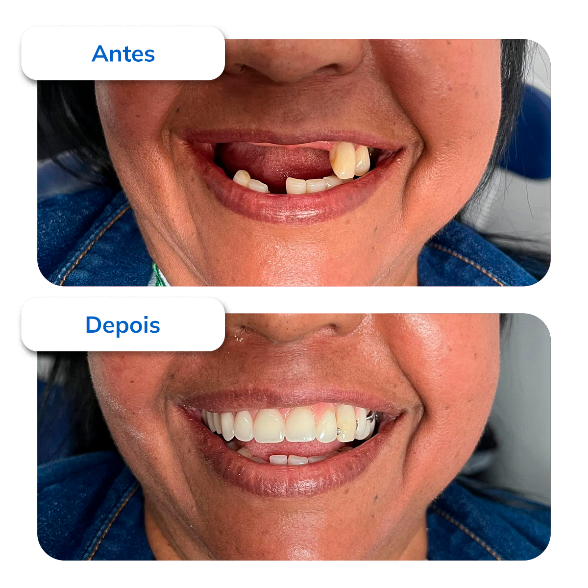 Próteses Dentárias